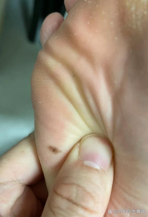 脚底有痣是好还是不好，没有读过书就赚不到钱