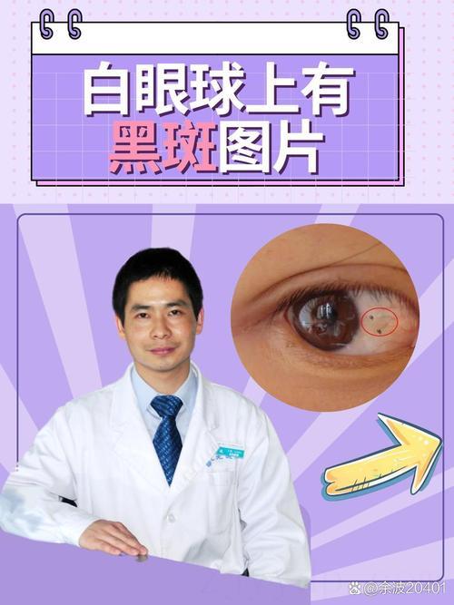 眼白里有黑斑是富贵命,眼白里有黑点是富贵命